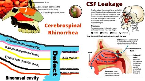 csf leak from nose test|CSF Leak Diagnosis 